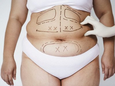 Ліпосакція при ожирінні