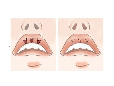 Хірургічне збільшення губ, VY пластику