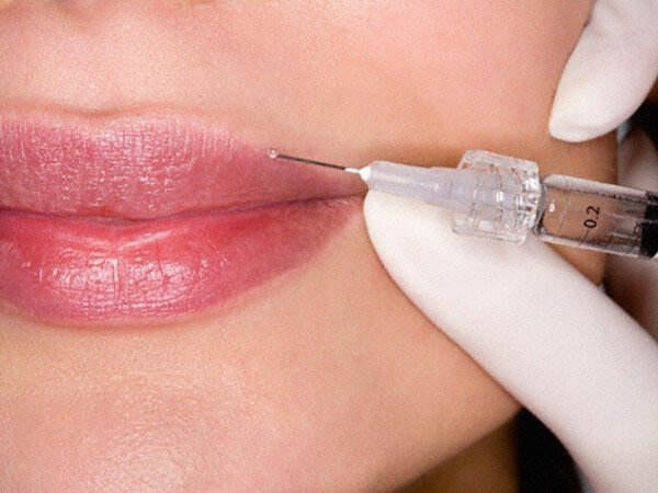 Особливості контурної пластики губ