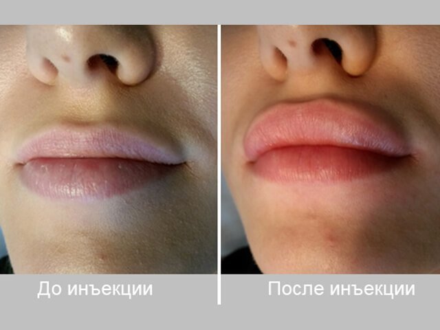 До і після пластики контуру губ