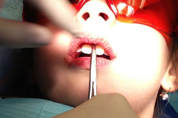 Операція по пластиці верхньої губи у дітей