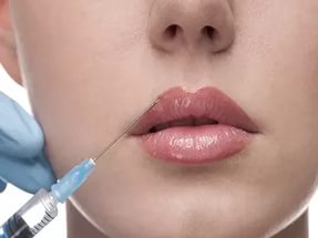 Процедура корекції губ гіалуроновою кислотою
