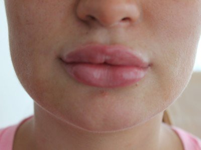 Набряк після контурної пластики губ