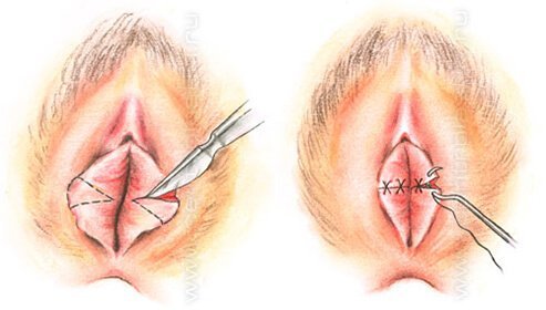 Пластична операція статевих губ або Лабіопластика