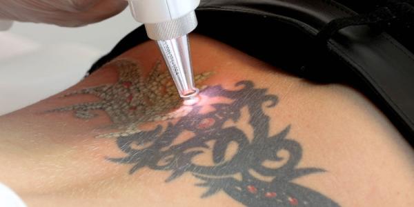 Лазерне видалення татуювання