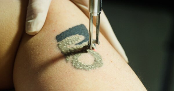 Видалення татуювання лазером