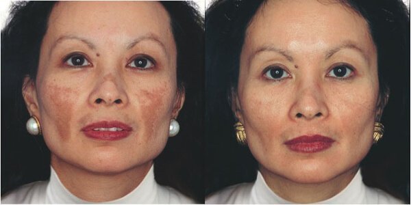 До і після видалення пігментних плям на обличчі