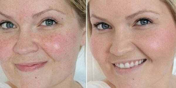 Лазерна чистка обличчя: до і після