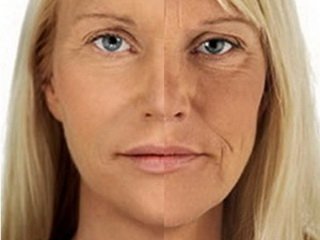 Показання до підтяжки шкіри обличчя і овалу