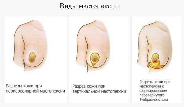 види мастопексії