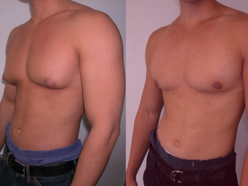 Ліпосакція грудей у ​​чоловіків: результати