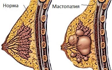 Після підтяжки грудей може розвинутися мастопатія