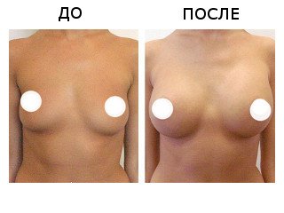 Ліполіфтінг грудних залоз: результати