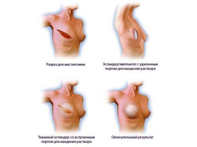 Реконструкція грудей після мастектомії