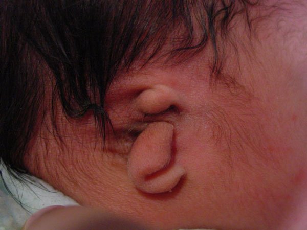Шви після корекції мочок вух