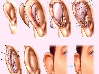 Операція з пластики вух