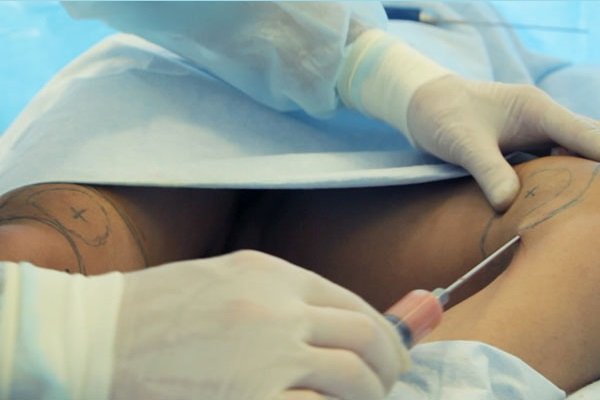 ліпосакція колін