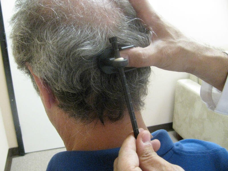 Як підбирається технологія пересадки волосся