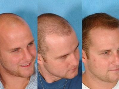 Результат пересадки волосся на голові у чоловіків