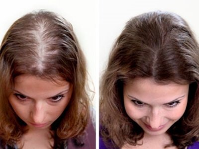 Результат пересадки волосся жінкам