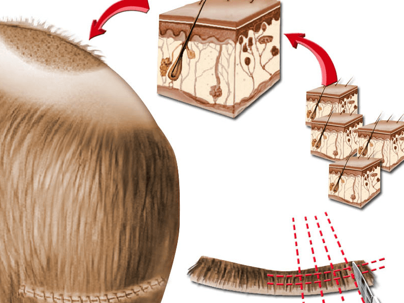 Операція з пересадки волосся: клаптевий метод