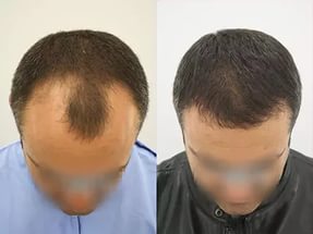 Пересадка волосся: до і після