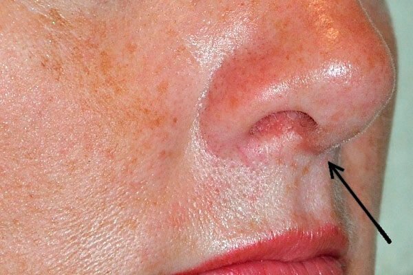Чи небезпечна ринопластика носа?