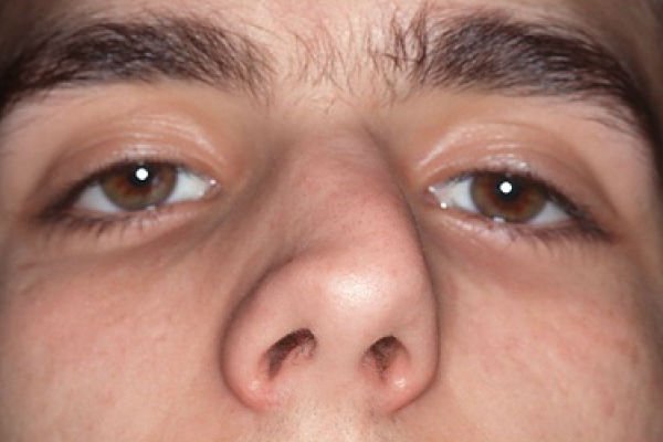 Деформація носа після ринопластики