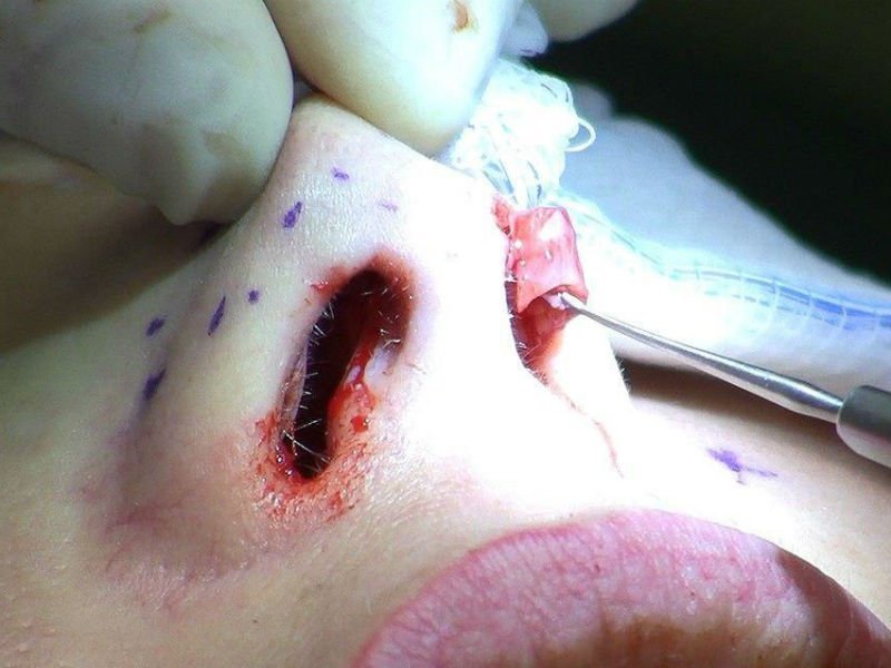 Ринопластика під місцевою анестезією