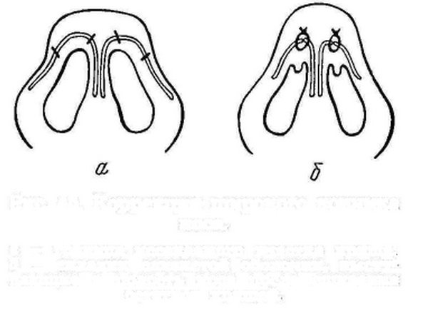 Схематичне зображення зшивання хрящів кінчика носа